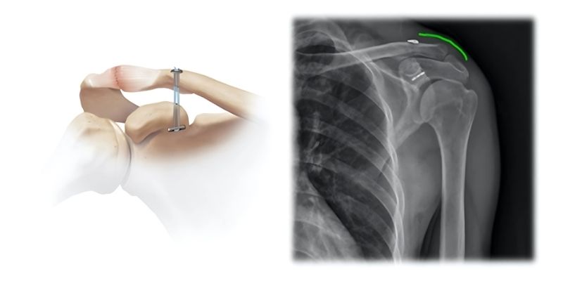 εξάρθρημα end-button