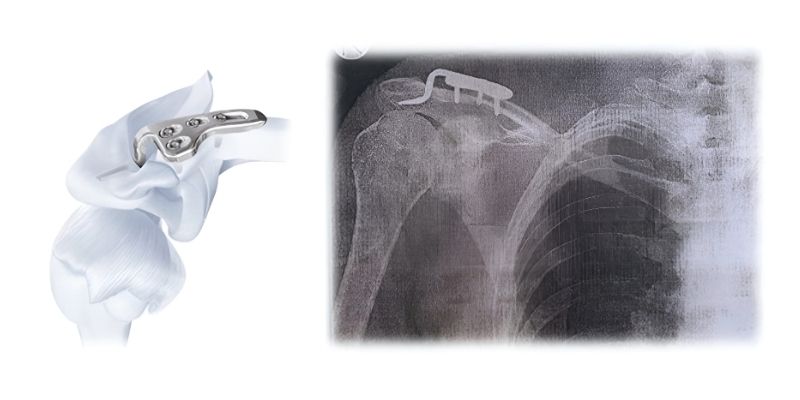 εξάρθρημα hook plate