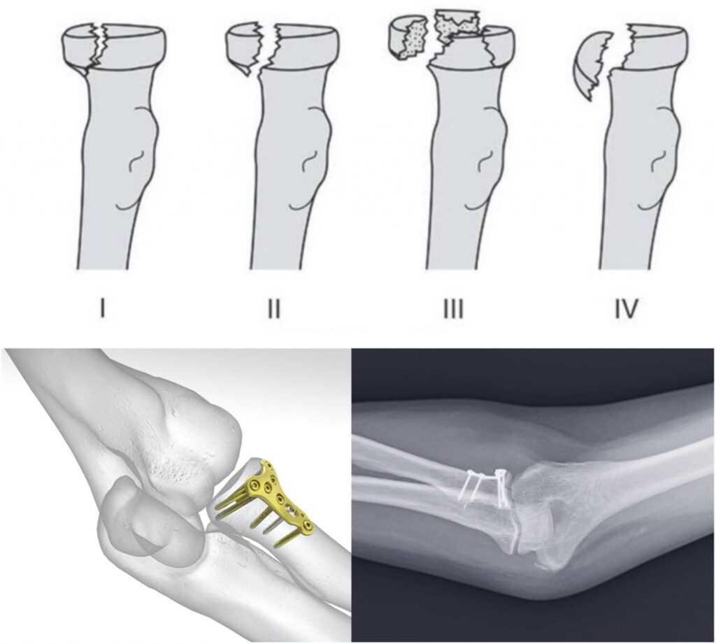 κάταγμα κεφαλής κερκίδας