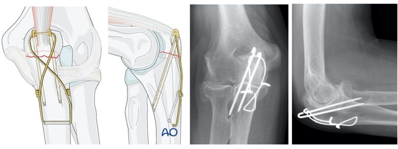 κάταγμα ωλεκράνου 2