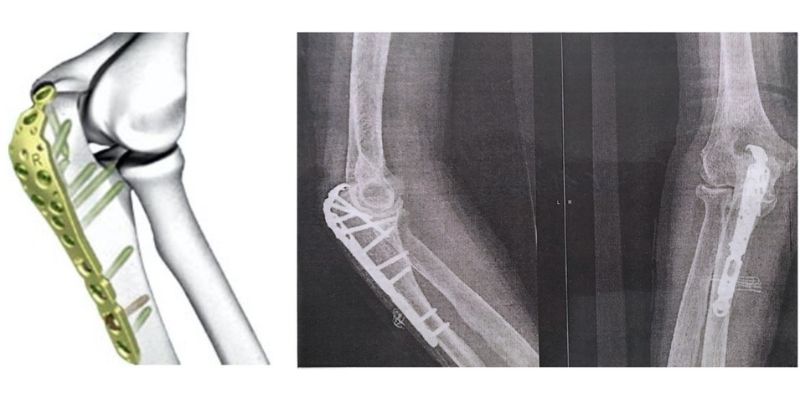 κάταγμα αγκώνα ωλεκράνου 1